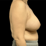 Breast Reduction Before & After Patient #1454