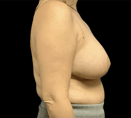 Breast Reduction Before & After Patient #1454