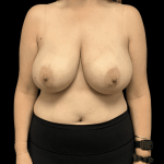 Breast Reduction Before & After Patient #1454