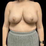 Breast Reduction Before & After Patient #1454