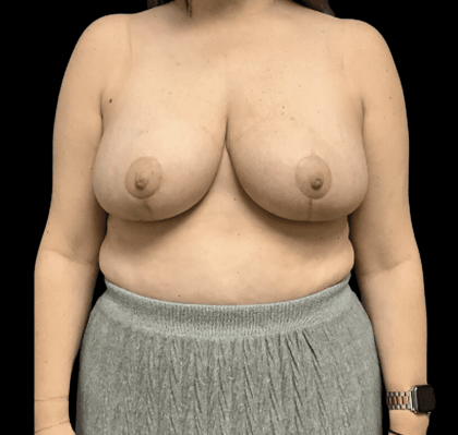 Breast Reduction Before & After Patient #1454