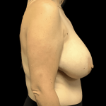 Breast Reduction Before & After Patient #1454
