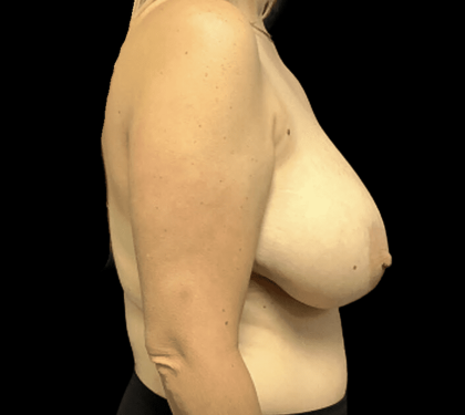 Breast Reduction Before & After Patient #1454