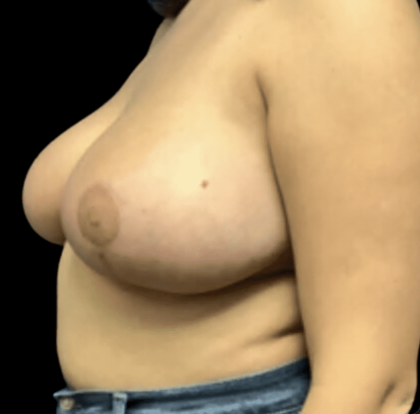 Breast Reduction Before & After Patient #1459