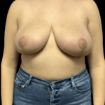 Breast Reduction Before & After Patient #1459
