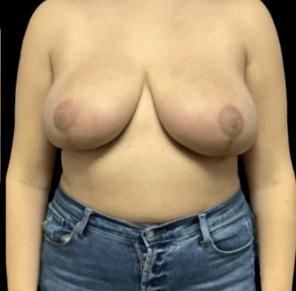 Breast Reduction Before & After Patient #1459