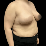 Breast Reduction Before & After Patient #1464