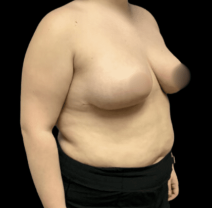 Breast Reduction Before & After Patient #1464