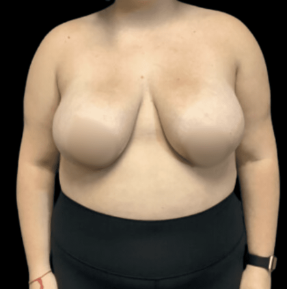 Breast Reduction Before & After Patient #1464