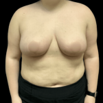 Breast Reduction Before & After Patient #1464