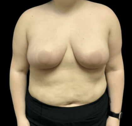 Breast Reduction Before & After Patient #1464