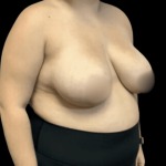 Breast Reduction Before & After Patient #1464