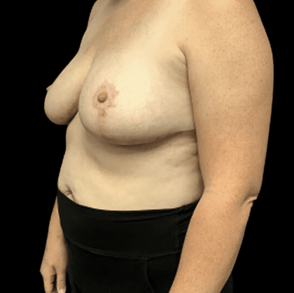 Breast Reduction Before & After Patient #1469