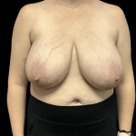 Breast Reduction Before & After Patient #1469