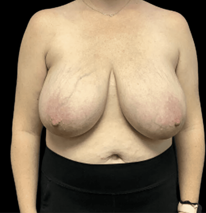 Breast Reduction Before & After Patient #1469