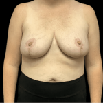 Breast Reduction Before & After Patient #1469