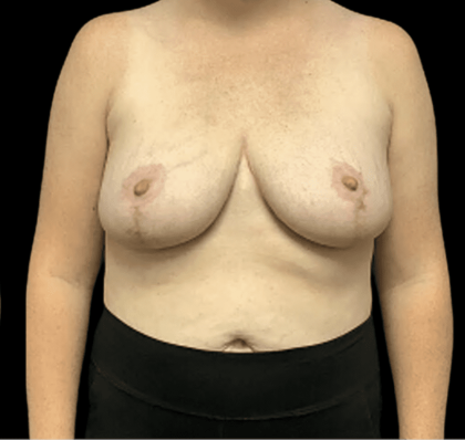 Breast Reduction Before & After Patient #1469
