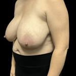 Breast Reduction Before & After Patient #1469