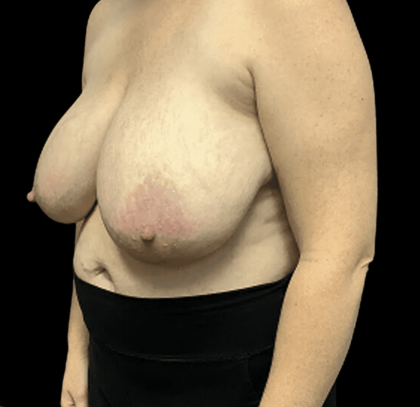 Breast Reduction Before & After Patient #1469