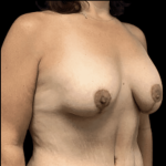 Breast Reduction Before & After Patient #1474