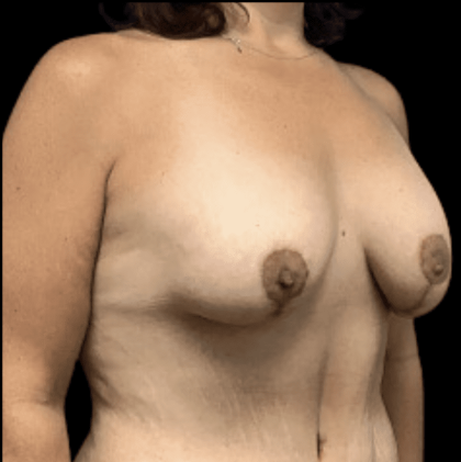 Breast Reduction Before & After Patient #1474