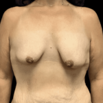Breast Reduction Before & After Patient #1474