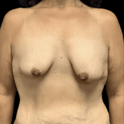 Breast Reduction Before & After Patient #1474