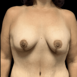 Breast Reduction Before & After Patient #1474