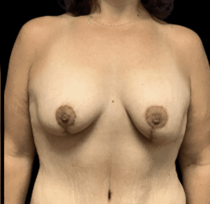 Breast Reduction Before & After Patient #1474