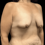 Breast Reduction Before & After Patient #1474