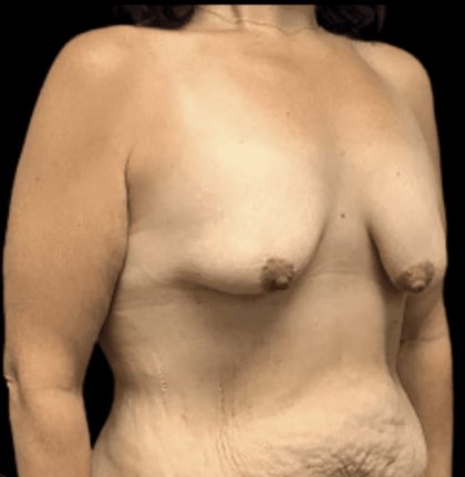 Breast Reduction Before & After Patient #1474