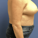 Breast Reduction Before & After Patient #1479