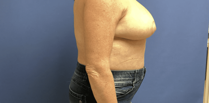 Breast Reduction Before & After Patient #1479