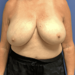 Breast Reduction Before & After Patient #1479