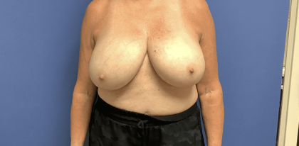Breast Reduction Before & After Patient #1479