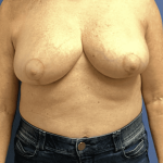 Breast Reduction Before & After Patient #1479