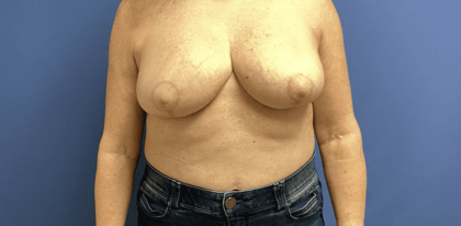 Breast Reduction Before & After Patient #1479