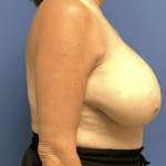 Breast Reduction Before & After Patient #1479