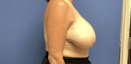 Breast Reduction Before & After Patient #1479