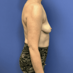 Breast Reduction Before & After Patient #1484