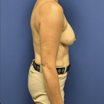 Breast Reduction Before & After Patient #1484