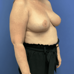 Breast Reduction Before & After Patient #1489