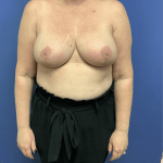 Breast Reduction Before & After Patient #1489