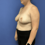 Breast Reduction Before & After Patient #1504