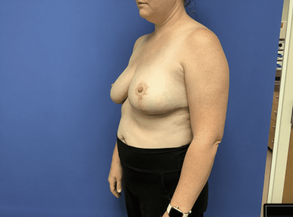 Breast Reduction Before & After Patient #1504
