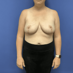 Breast Reduction Before & After Patient #1504