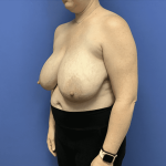 Breast Reduction Before & After Patient #1504