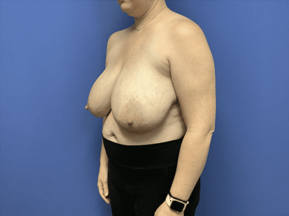 Breast Reduction Before & After Patient #1504
