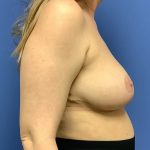 Breast Reduction Before & After Patient #1509
