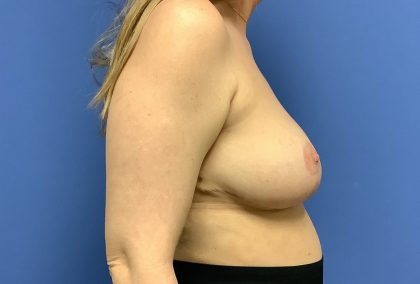Breast Reduction Before & After Patient #1509